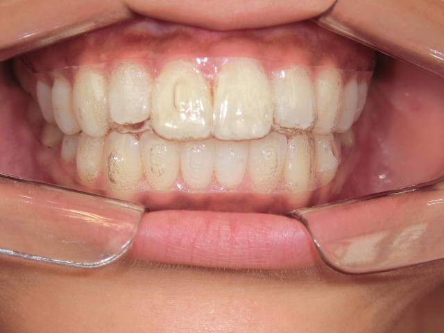 マウスピース矯正(スマイルトゥルー)症例　20代女性＜当院勤務の歯科衛生士＞術前