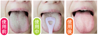 舌磨きで感染症予防