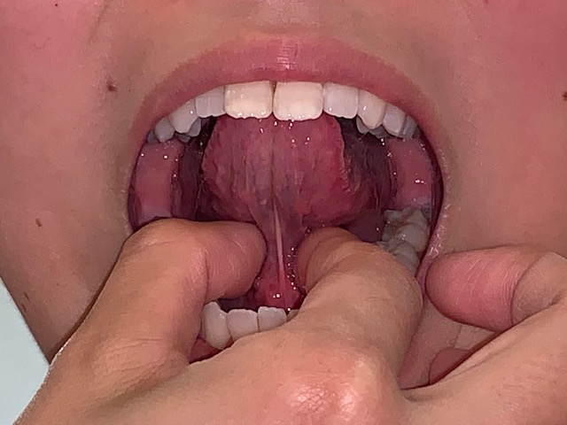 舌をはがす？！