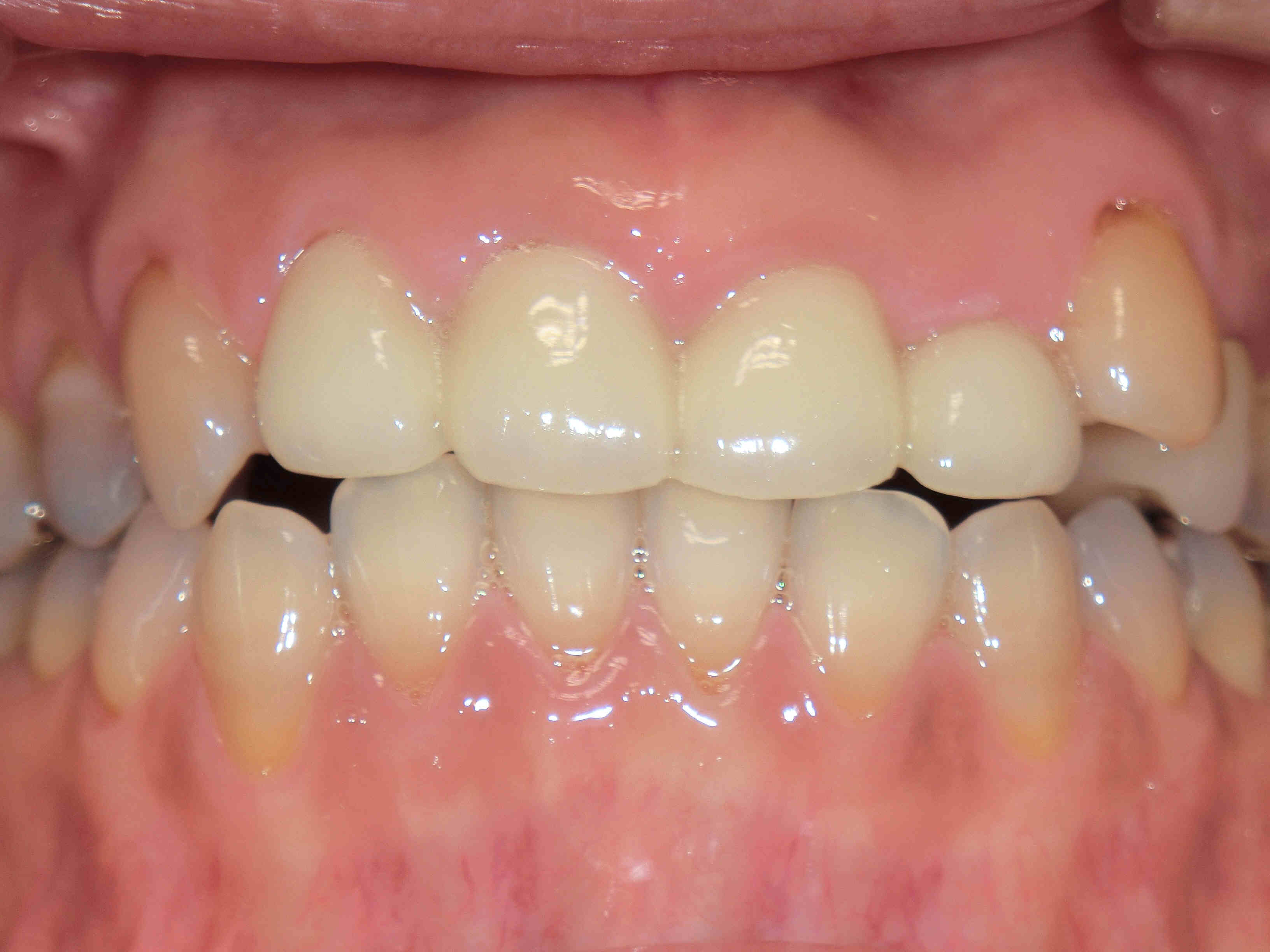 ５０代女性のセラミック冠による上顎前歯の審美回復症例